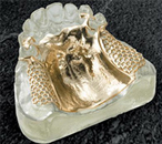 金属床義歯(メタルプレート)